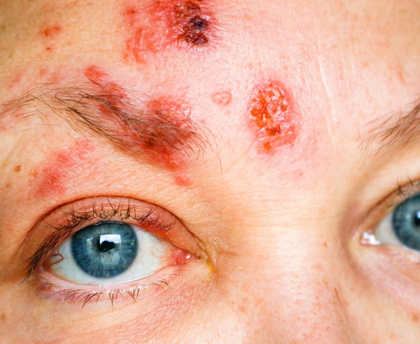 You Might Be Mistaking Herpes for Acne (Here’s How to Tell)