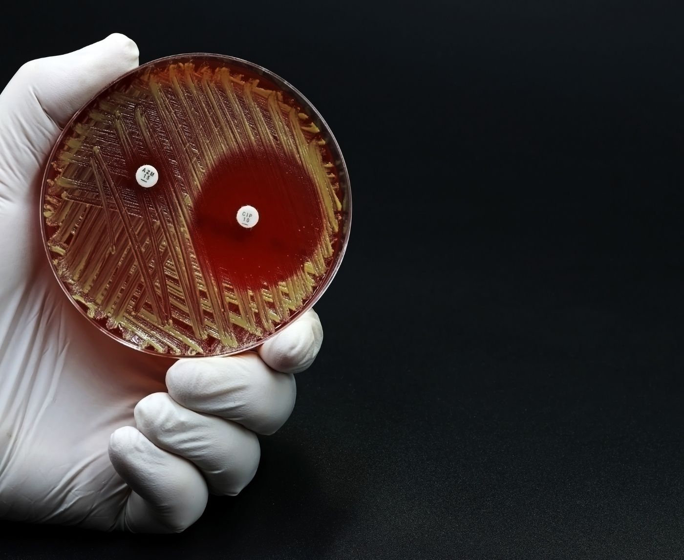 Super Gonorrhea Is Spreading. Are You at Risk?