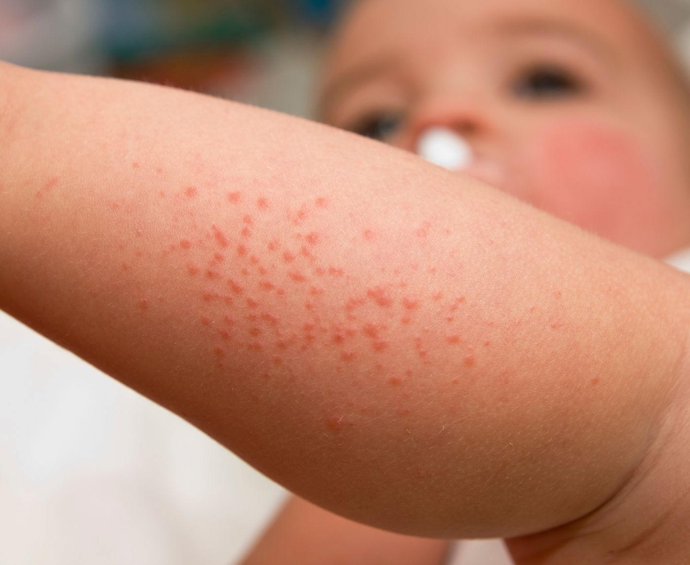 What Syphilis Looks Like in Newborns (And Why It’s Often Missed)