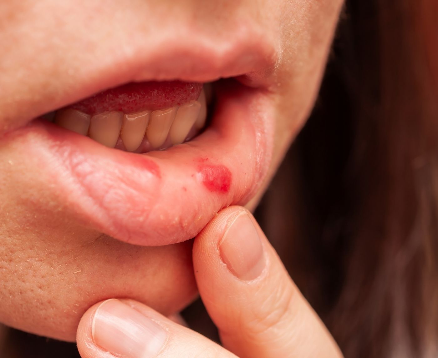 Worried Your Cold Sore Is Actually Syphilis? Here’s How to Know