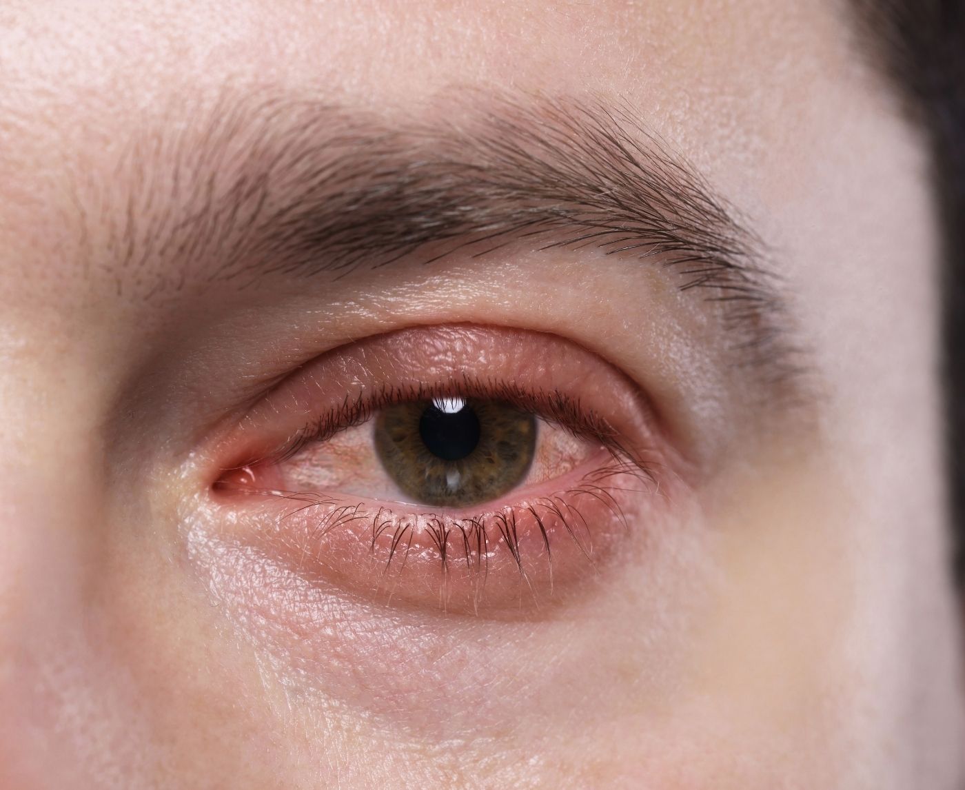 Gonorrhea in the Eye: Symptoms, Treatment, and Urgent Signs