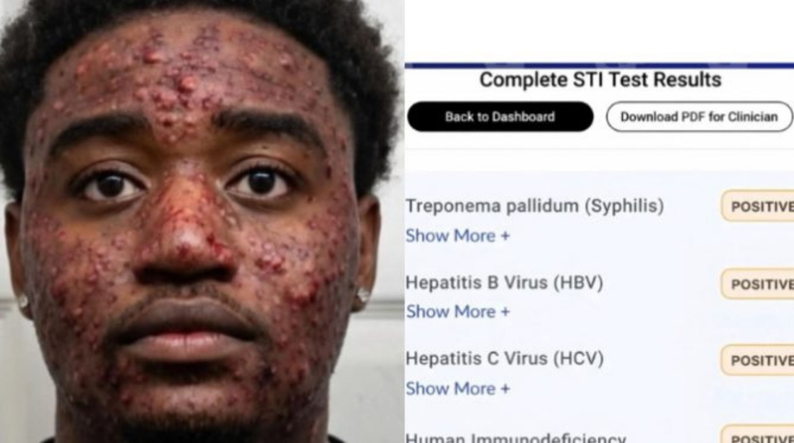 Can You Test Positive for Multiple STDs at the Same Time?