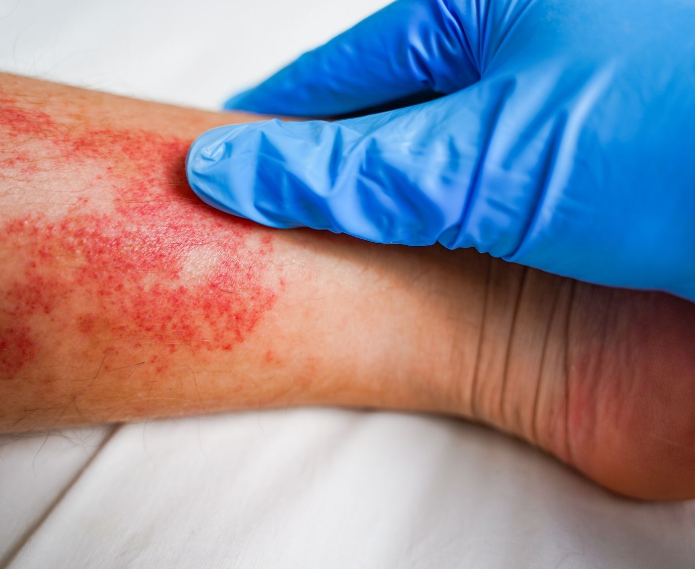 STD or Something Worse What Donovanosis Actually Does