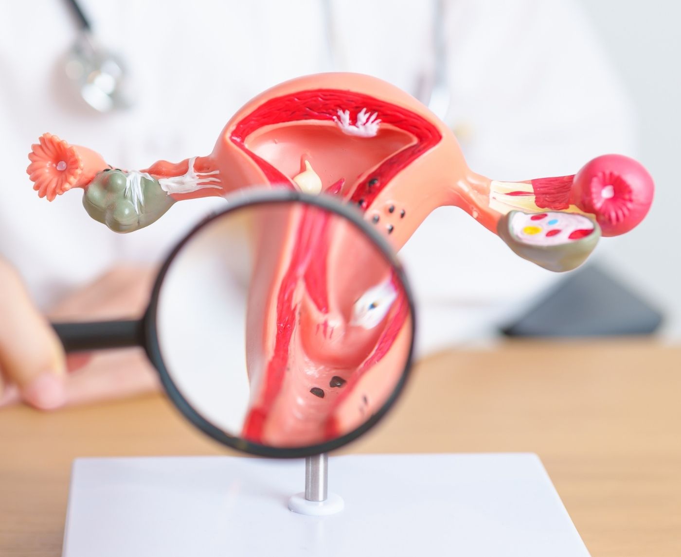 When Endometriosis Symptoms Might Actually Be Chlamydia or PID