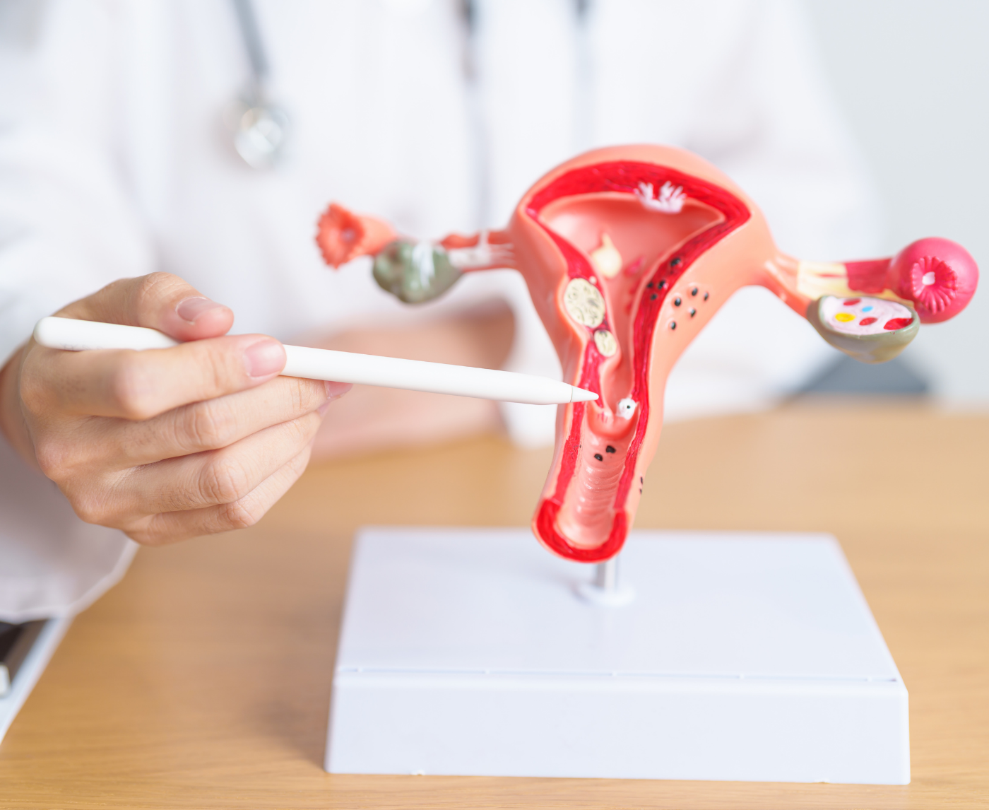STD or Endometriosis Why the Symptoms Get Confused