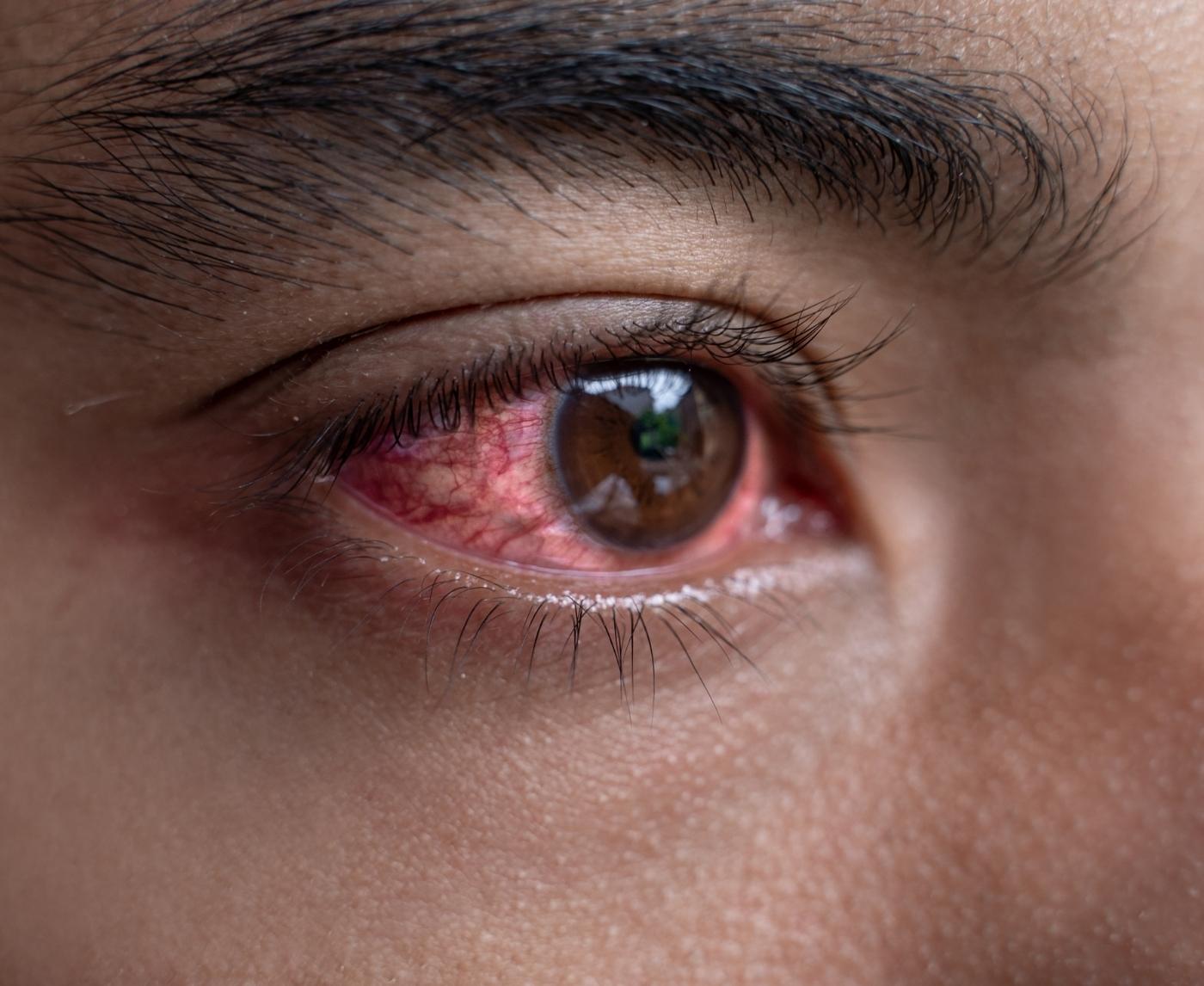 How to Know If That Eye Infection Might Actually Be an STD