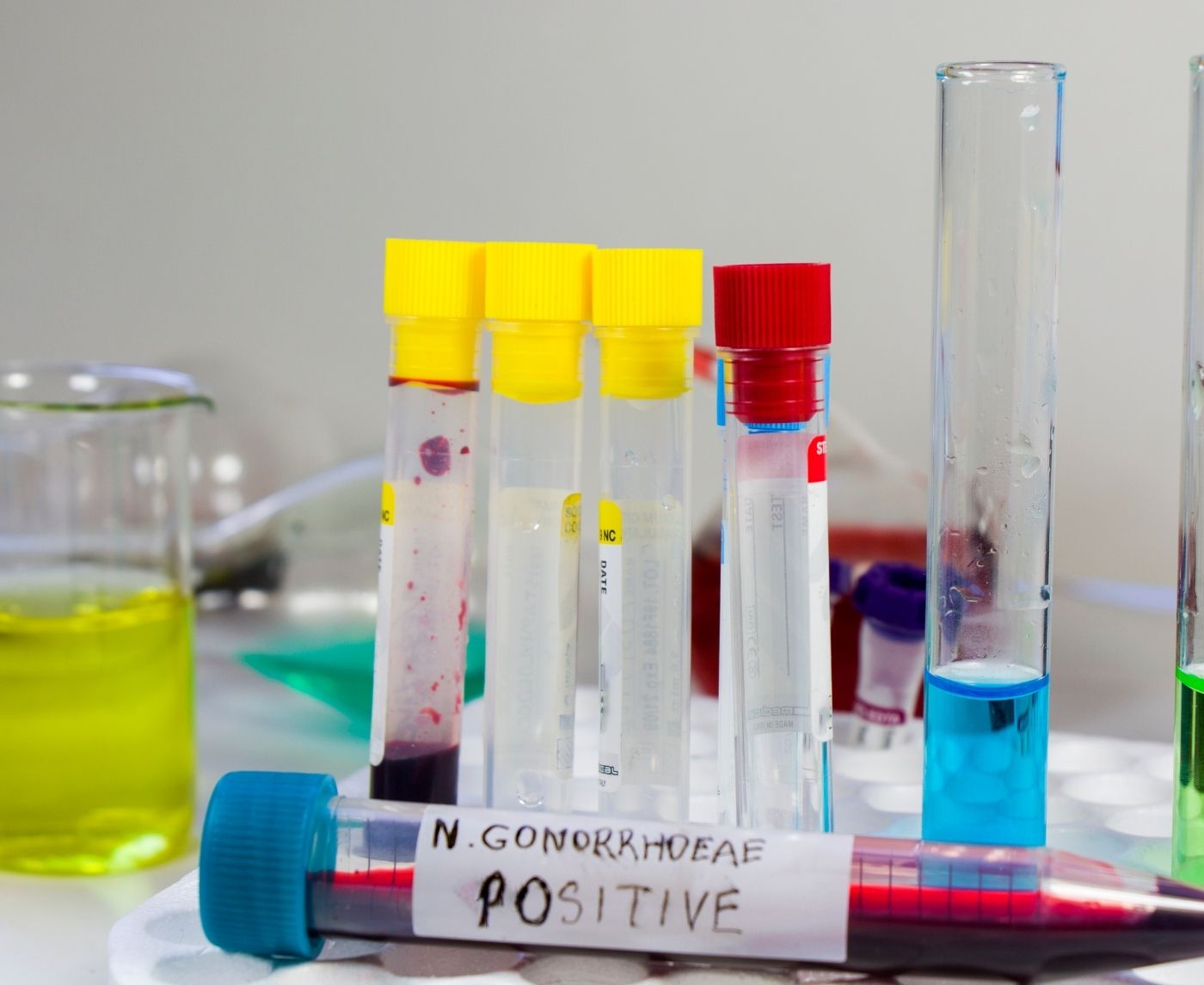 Tested Negative, Still Infected? Why Super-Gonorrhea Is Hard to Catch