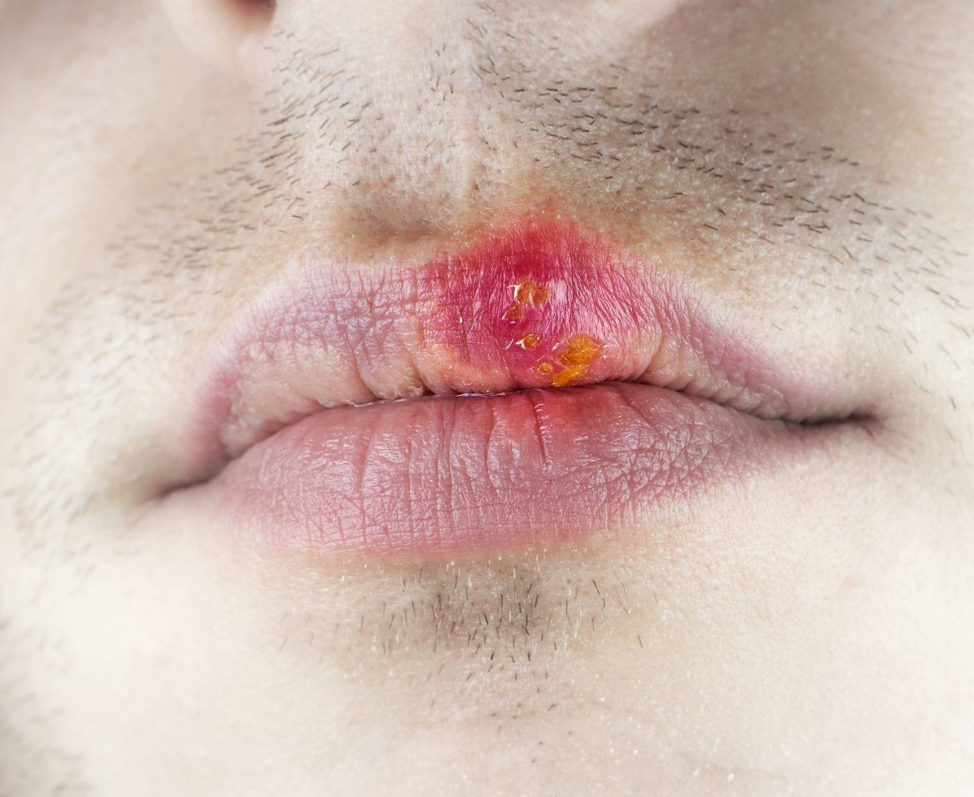 What No One Tells You About Oral STDs in Bi Men