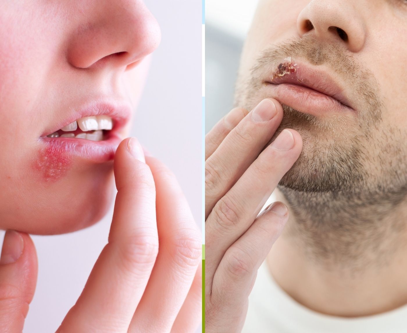 Herpes Flare Cycles in Women vs Men