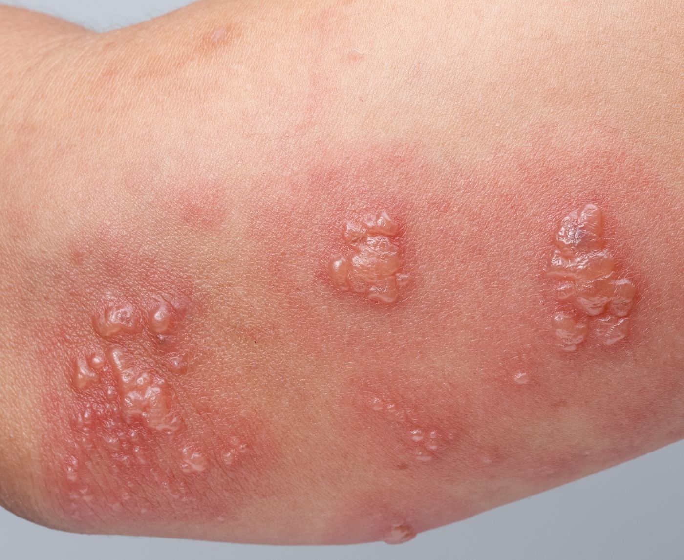 Does Herpes Cause Cancer? What the Research Really Shows