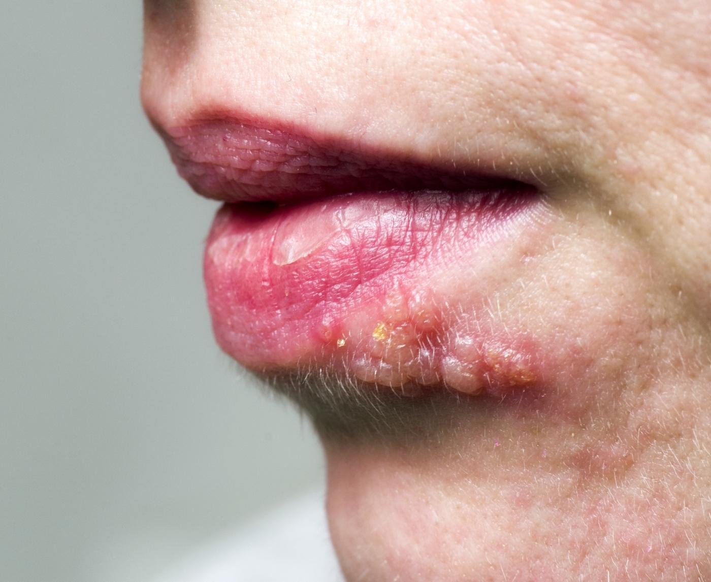 Cold Sore or Herpes? Why That Blister Deserves a Second Look