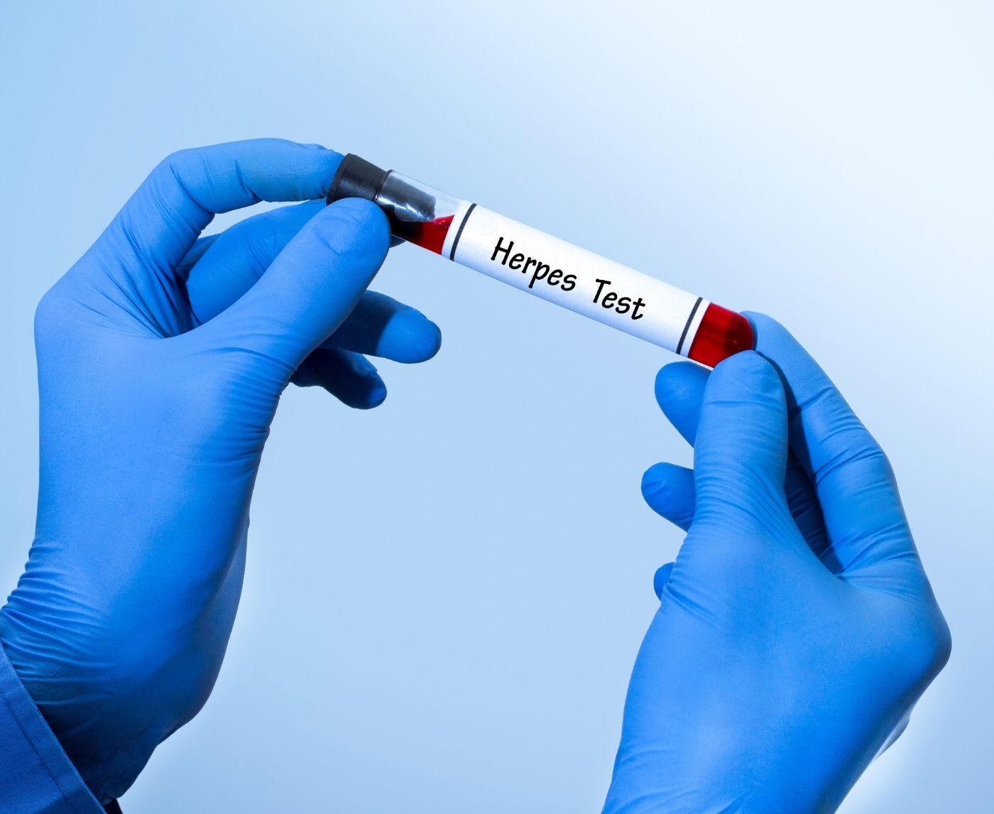Herpes Testing Explained: Why One Method Misses More Than You Think