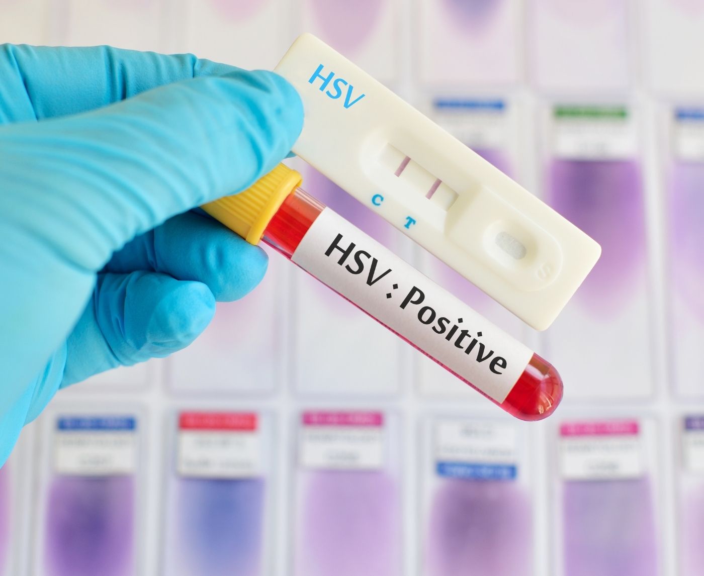 You Can Now Test for Herpes Without a Doctor