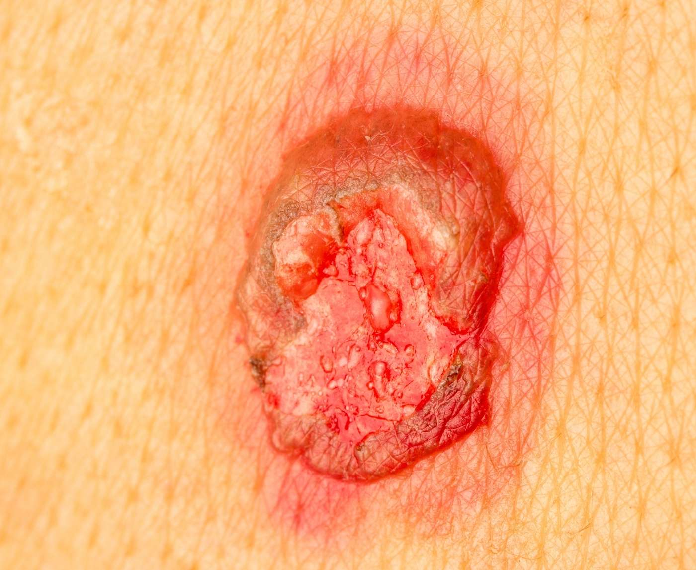 The Forgotten STD: Why No One Talks About Donovanosis (Until It’s Too Late)