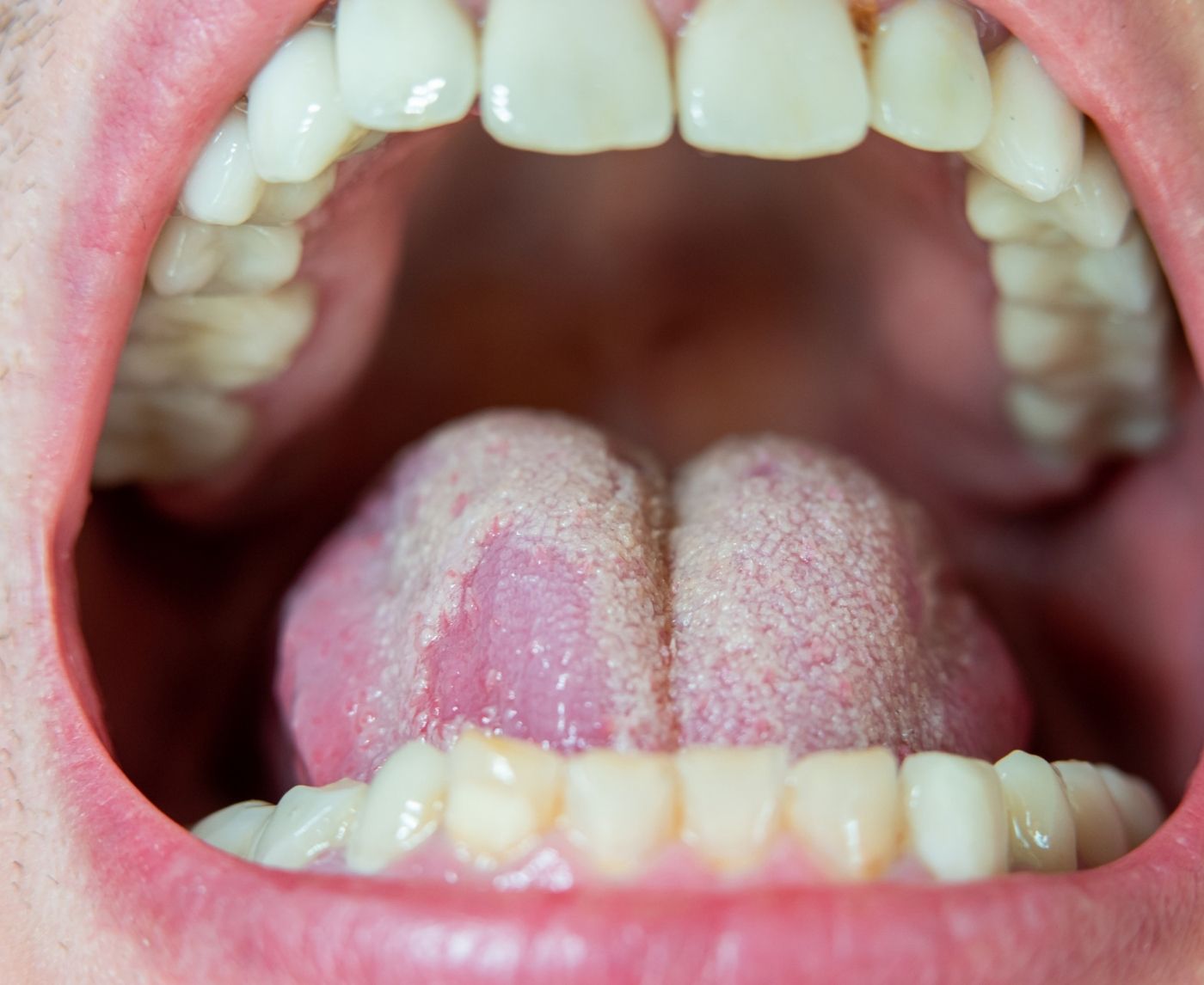 Can You Get Chlamydia in Your Throat? Yes, Here’s What It Feels Like
