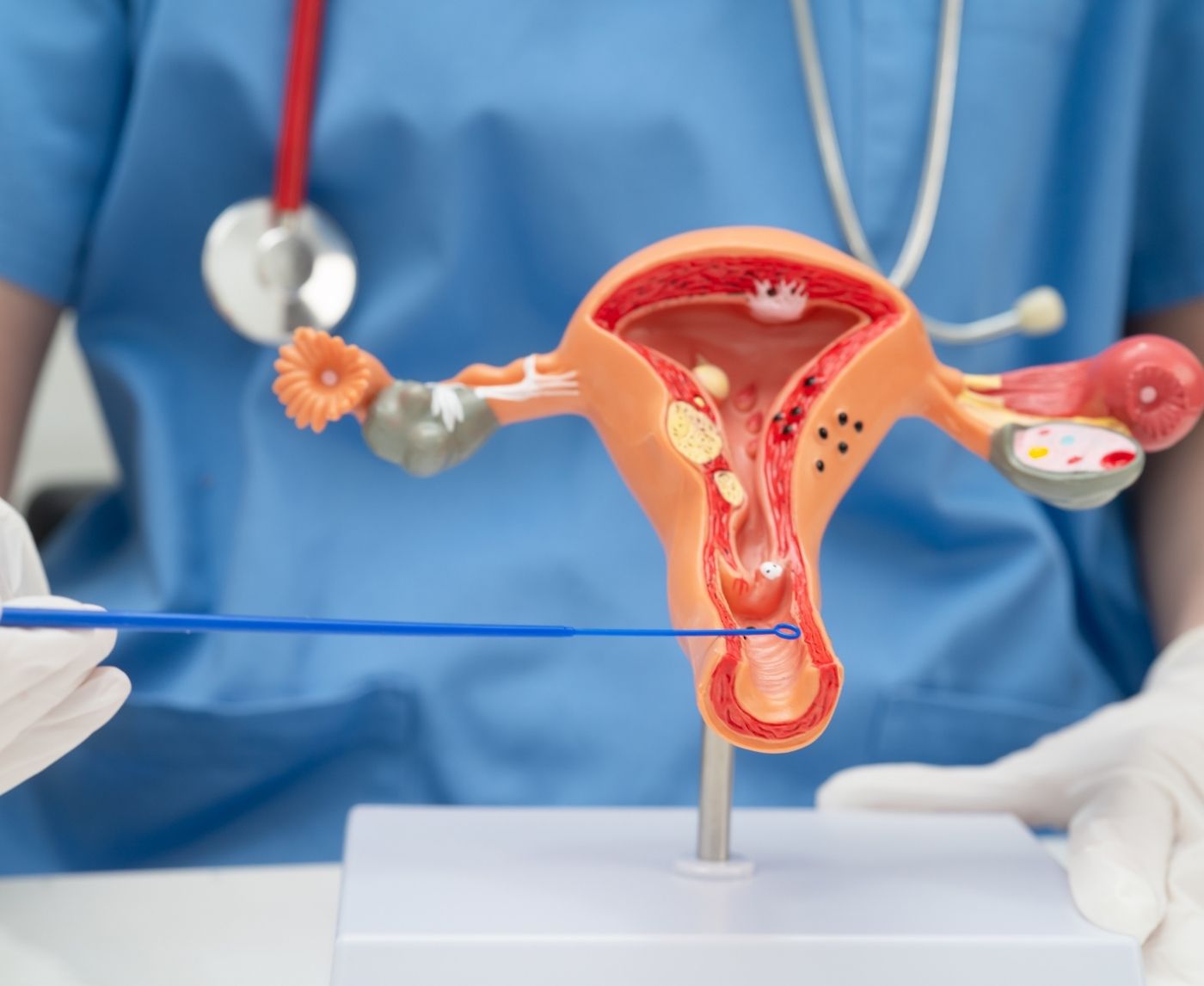 At-Home HPV Test or Pap Smear? Here's How to Choose