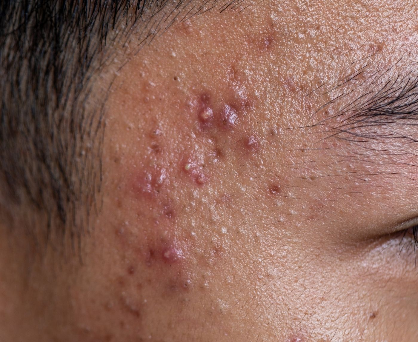 It Looked Like a Pimple It Was Herpes.