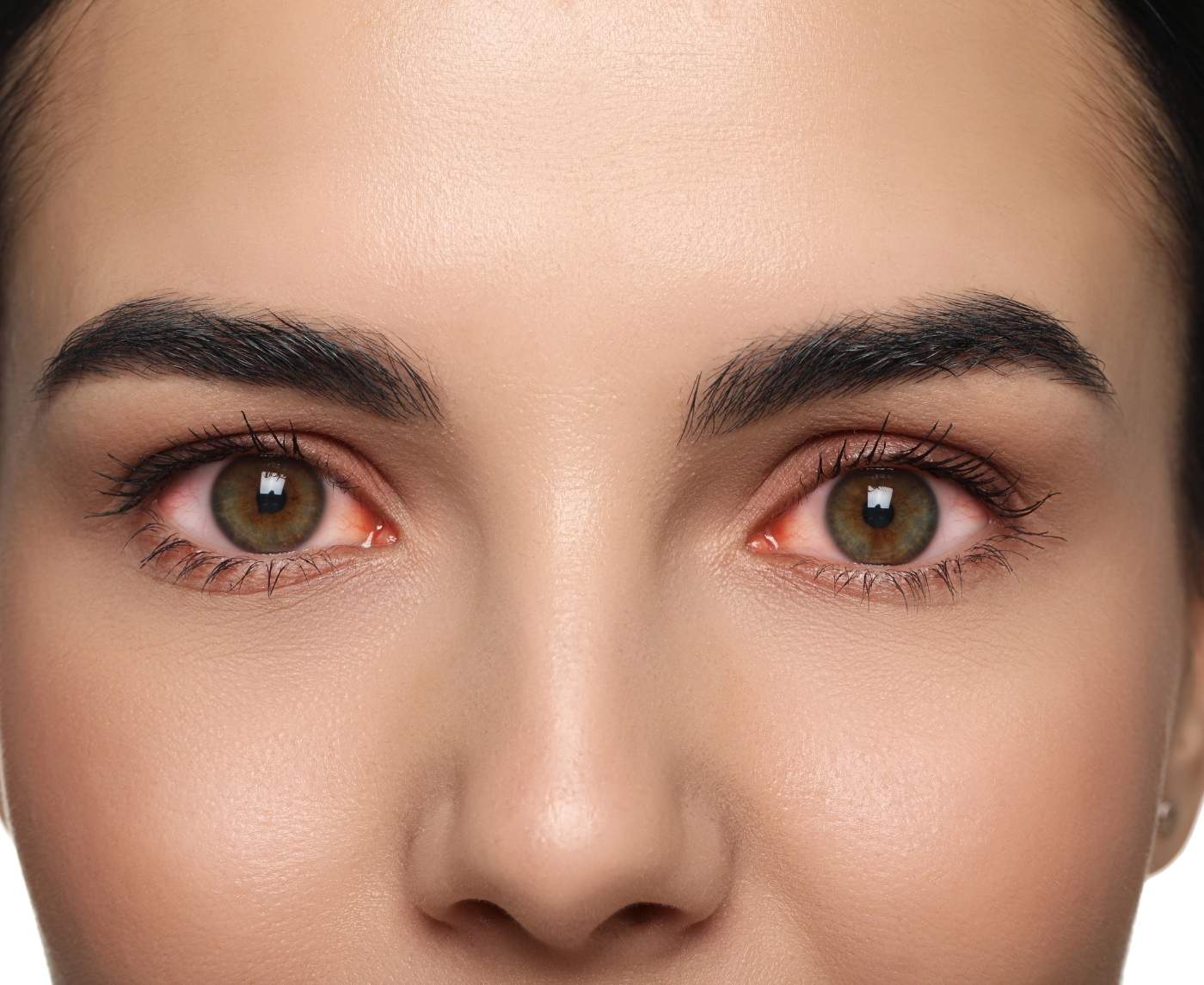 When Pink Eye Is Actually an STD: What to Look For