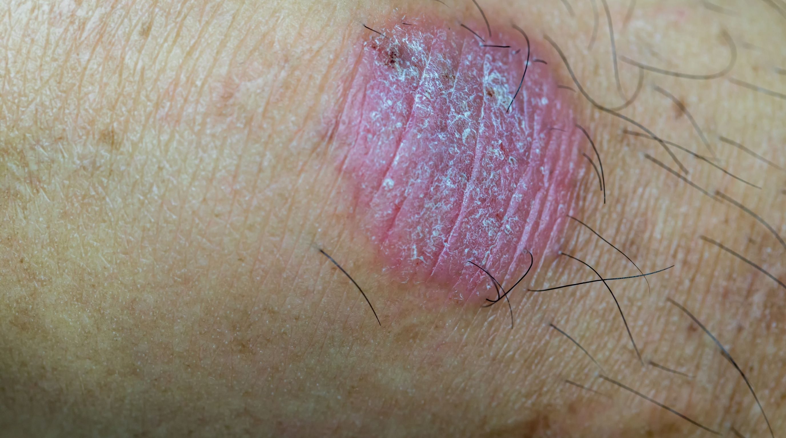 I Think I Saw a Chancre, What Should I Do? 