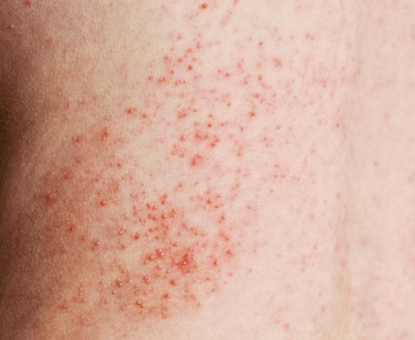 Can Heat Rash Be an STD? Here’s When to Worry