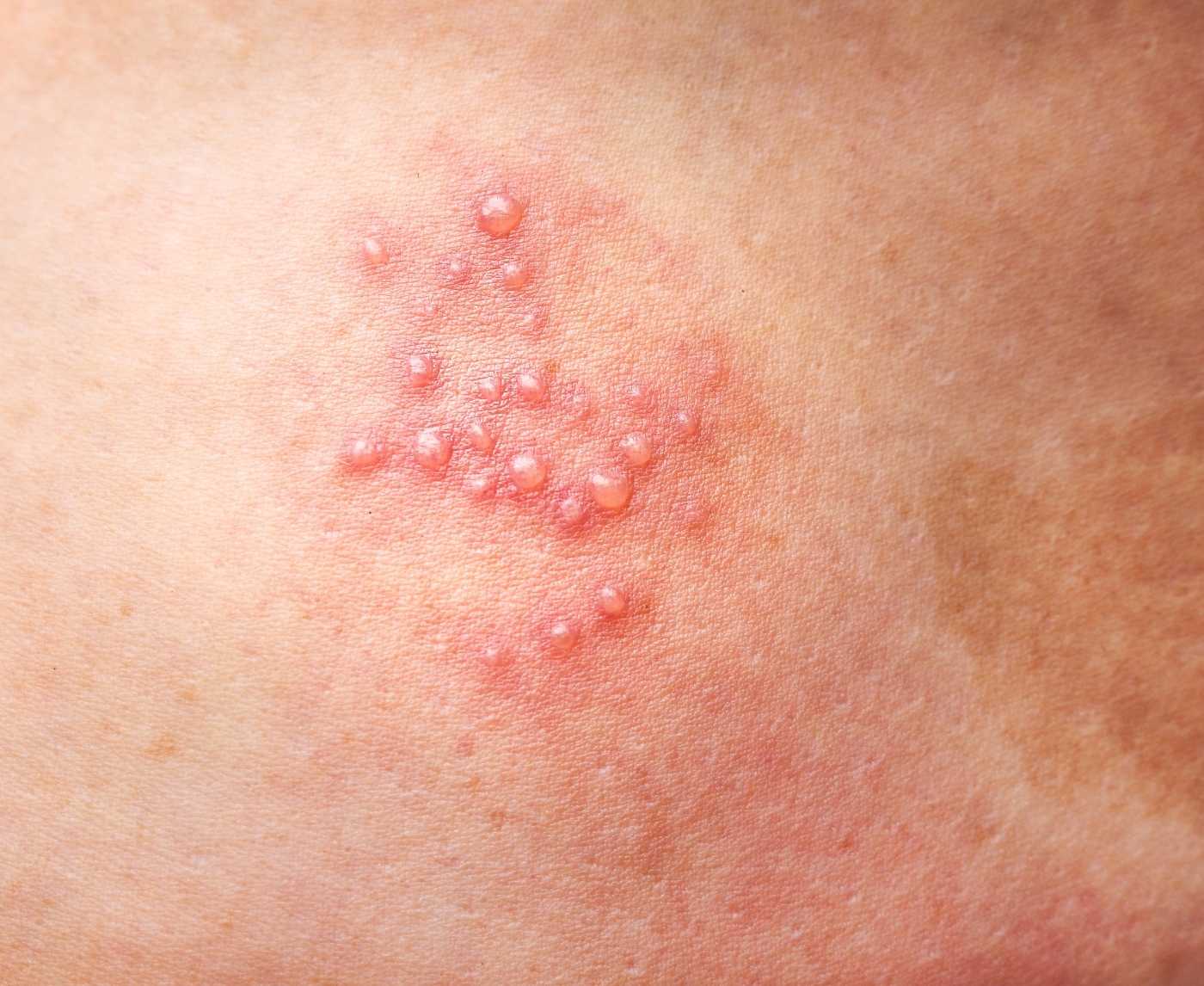 STD or Skin Irritation? What Red Spots on Your Vagina Really Mean