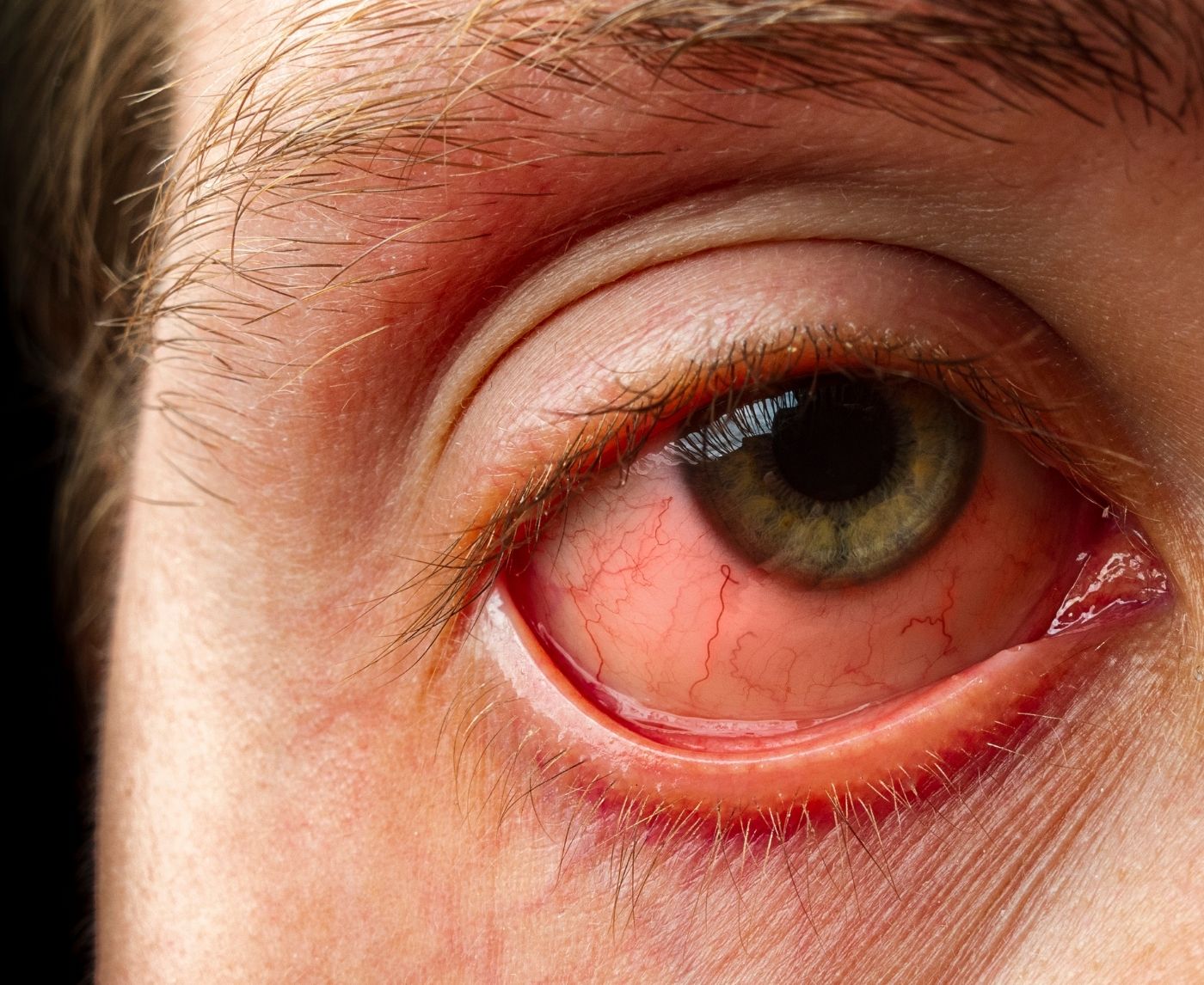 You Gave Oral Now Your Eyes Red Could It Be Gonorrhea