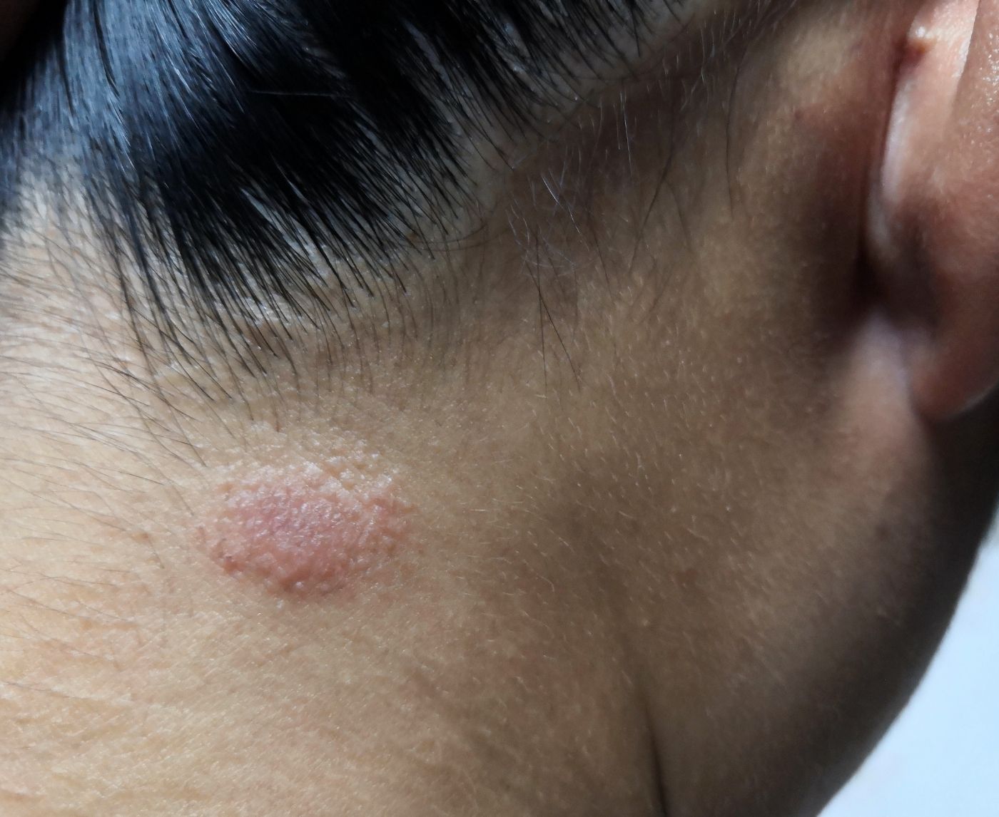 Sexually Transmitted Fungus Outbreak: What This Ringworm STI Means for You