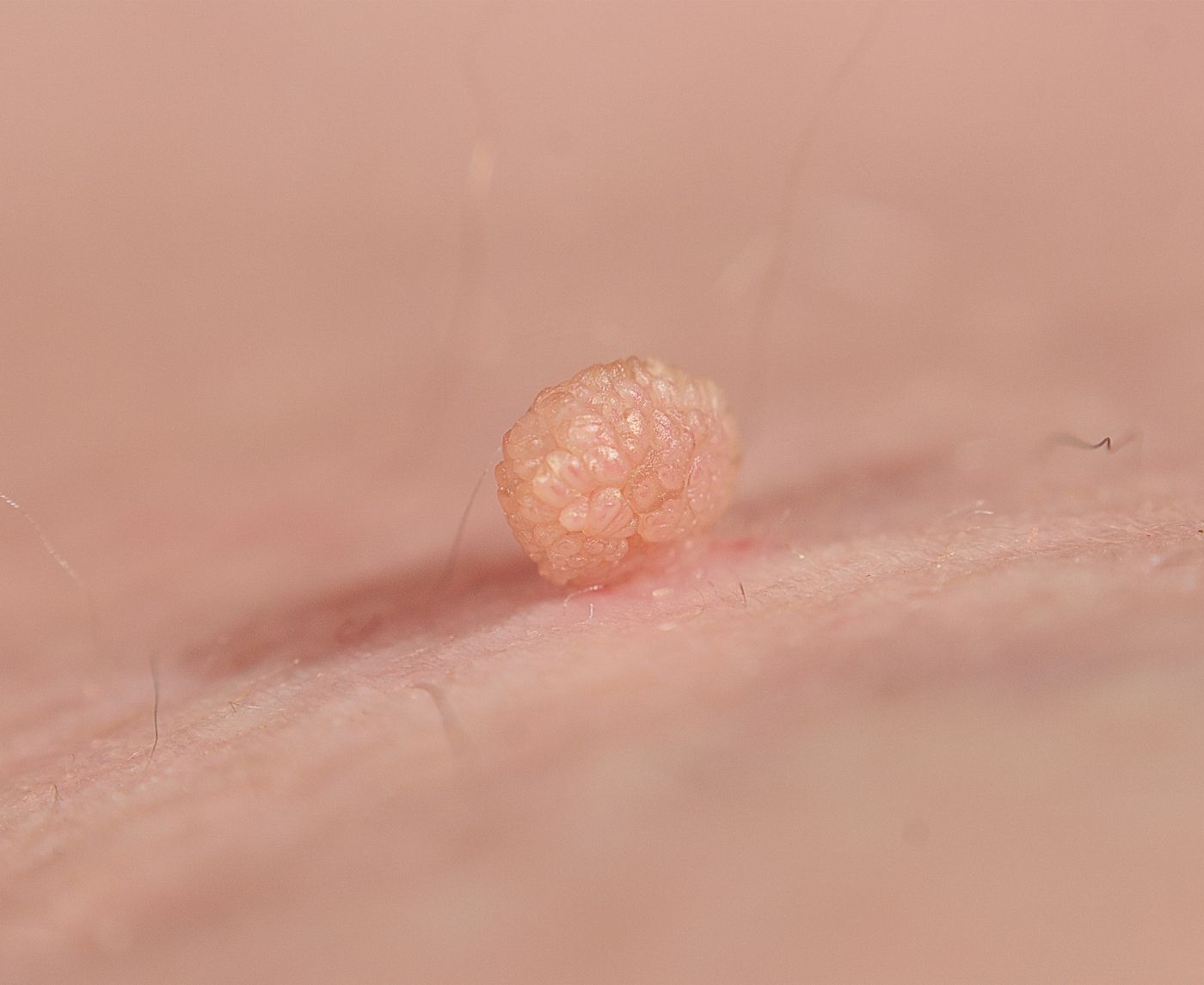 HPV Symptoms in Men: Warts, Lesions, or Nothing at All?