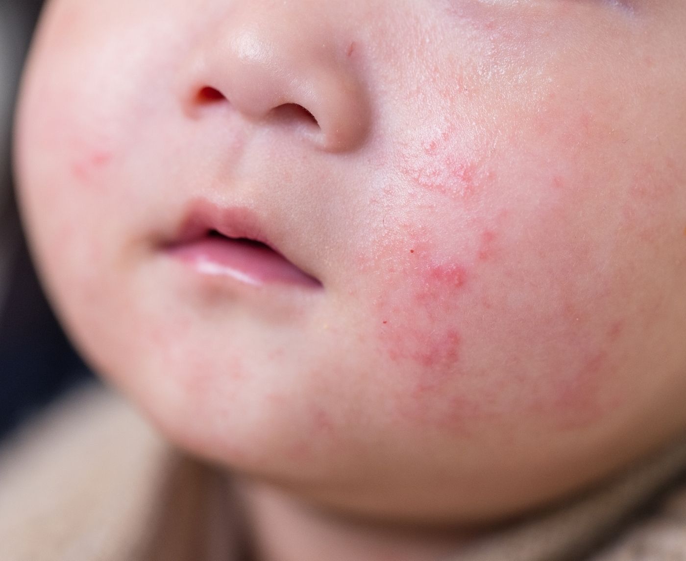 Cold Sores to Hepatitis: STDs Kids Can Get Without Any Abuse
