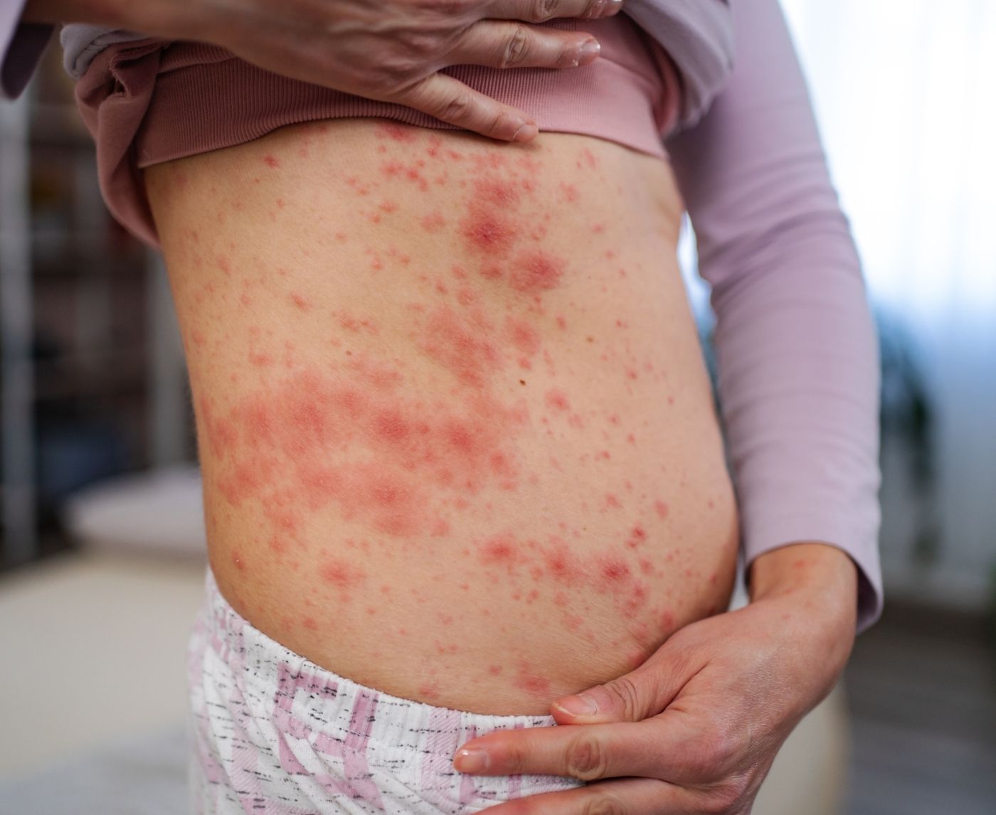 Rash After Sex: Allergy, Friction, or STD?