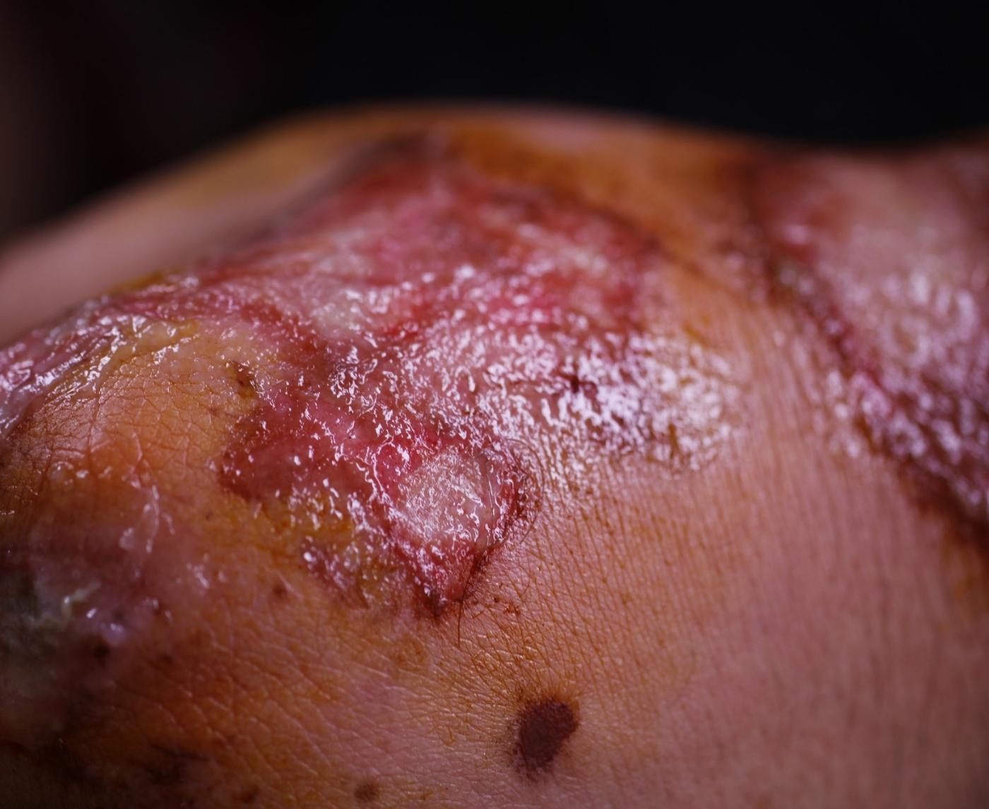 What the Hell Is Donovanosis, And Why It’s Surging in Australia and the U.S.