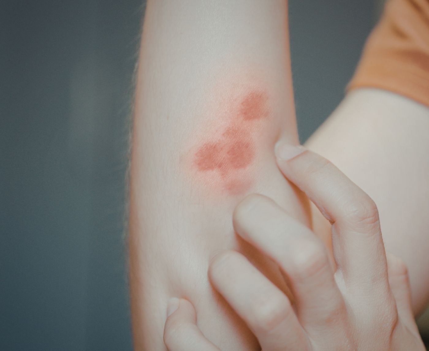 Syphilis Rash vs Heat Rash: How to Tell the Difference