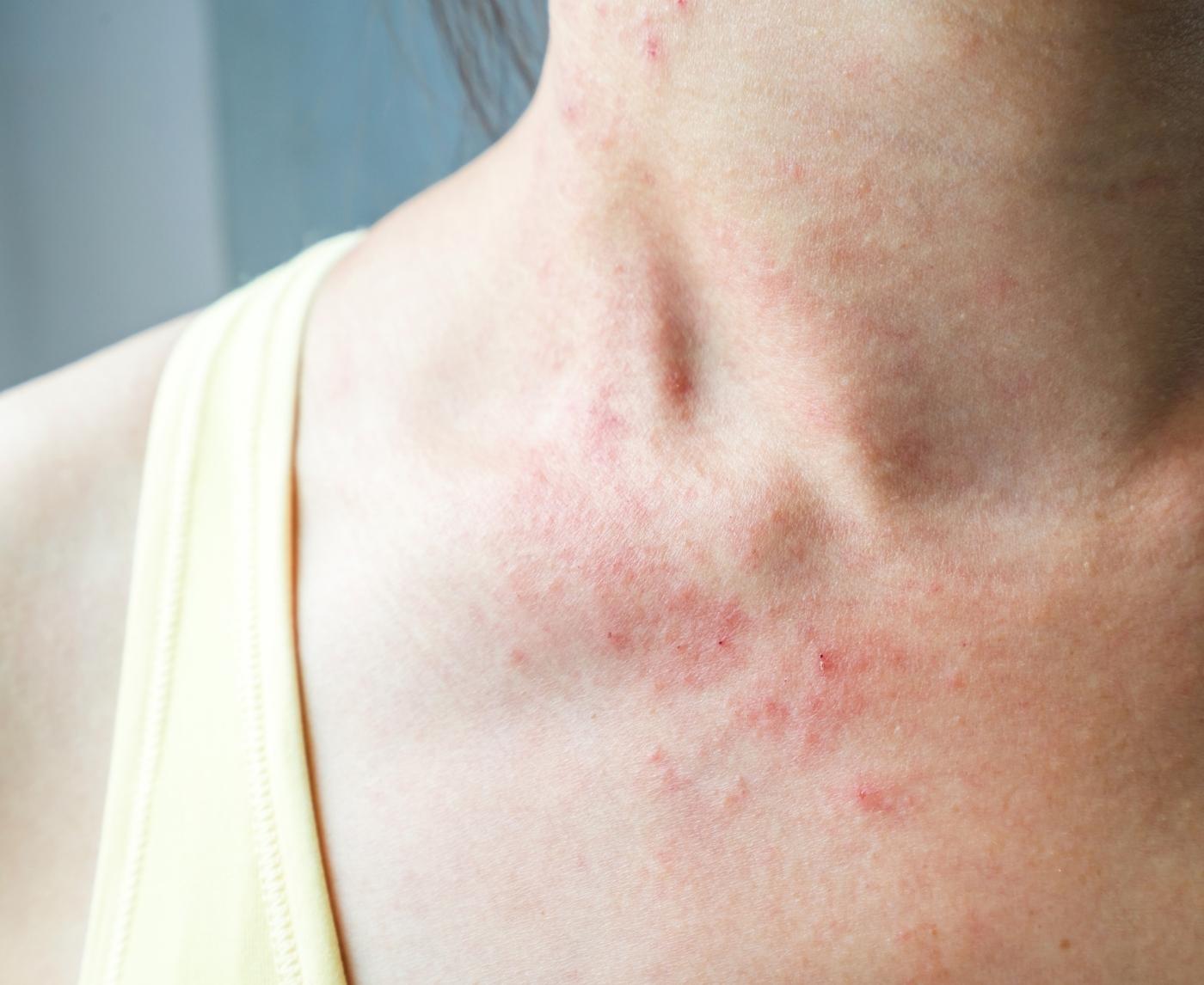 Think It’s Just a Skin Thing? Syphilis Rashes Are Trickier Than You Think