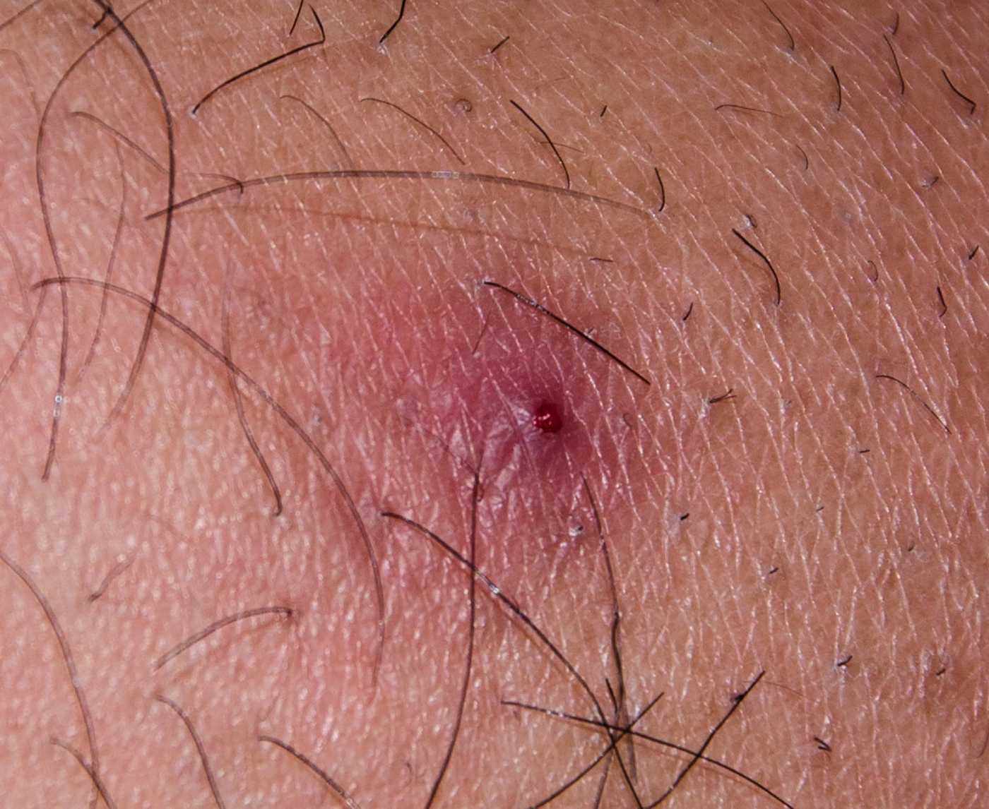 Syphilis vs Herpes: How to Tell the Difference