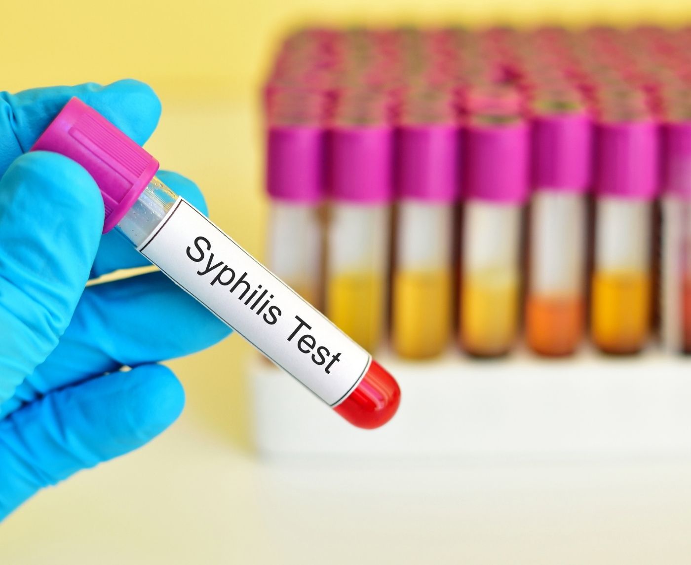 Syphilis Is Surging Again Heres How At-Home Testing Fits Into the Solution