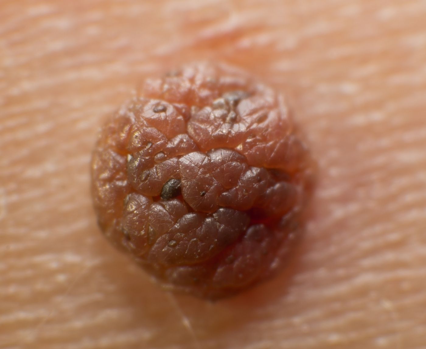 Do Genital Warts Mean You Have Cancer? Here’s the Real Risk