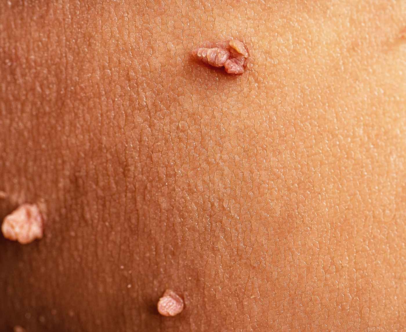 Is That HPV? What Red Bumps, Warts, and Silent Symptoms Mean
