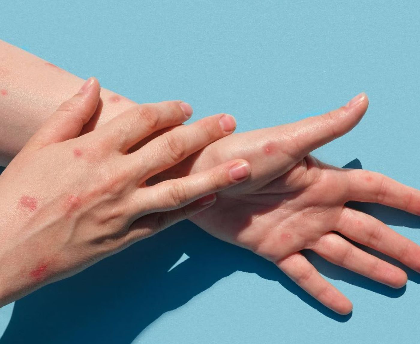 What the New Mpox Cases Say About STI Stigma and Vaccine Access in 2026