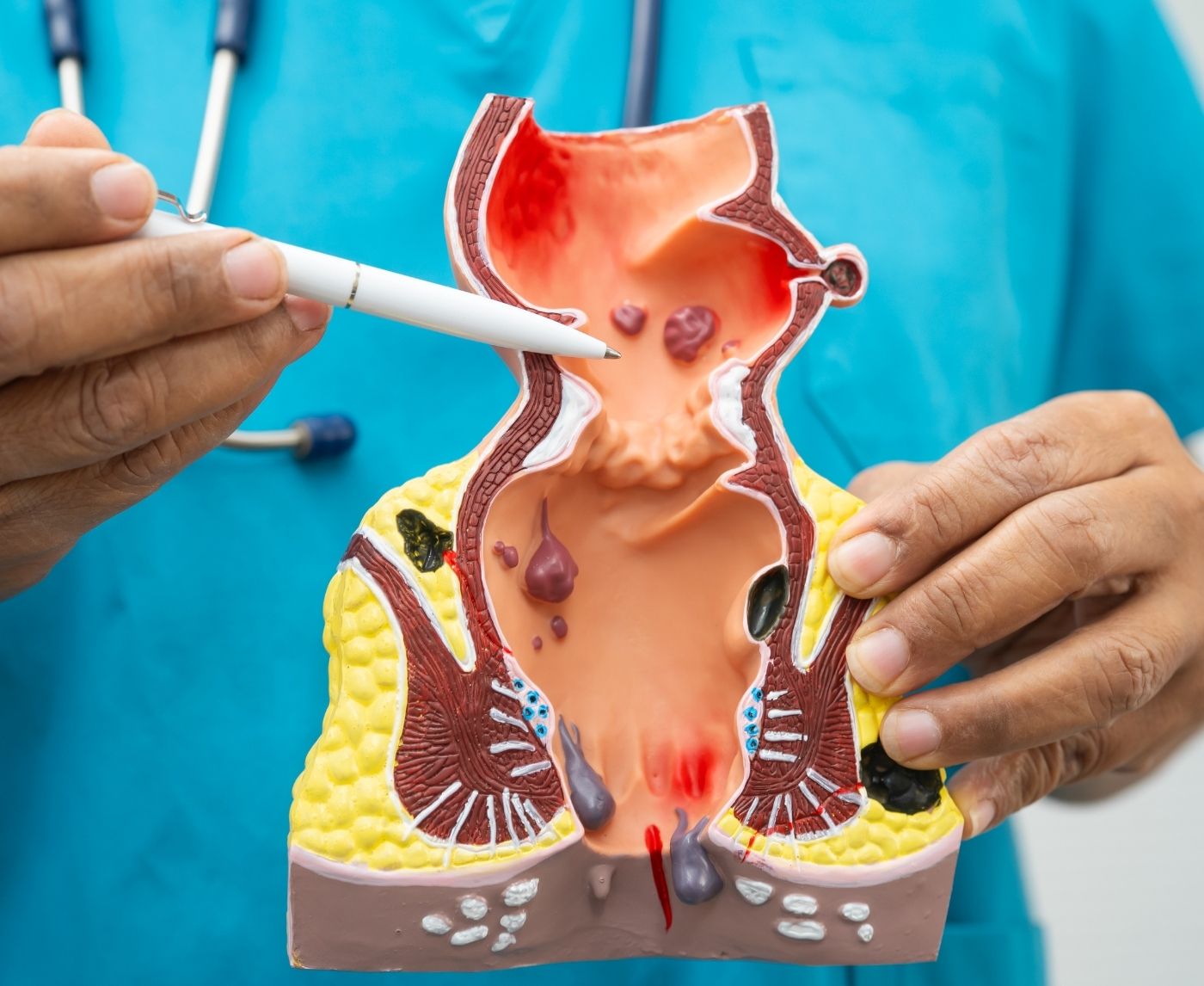 Hemorrhoids or Herpes? How to Tell the Difference in Anal Symptoms