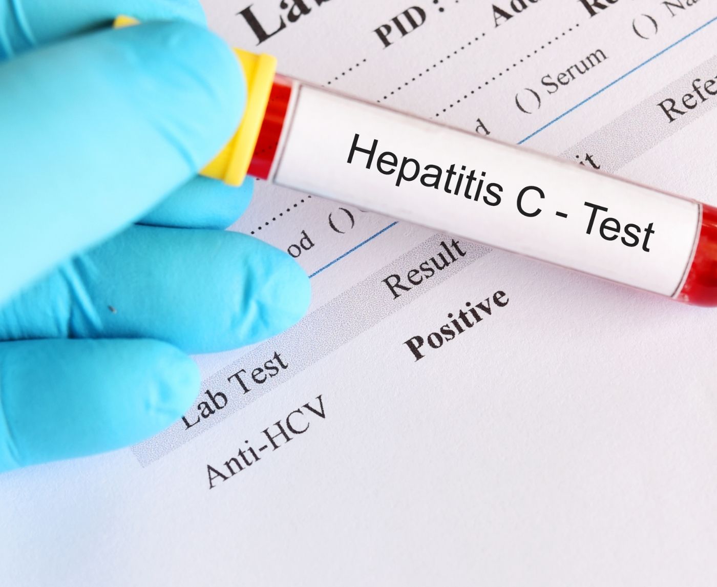 What to Do After a Positive Hepatitis C Test, No Panic, Just Steps