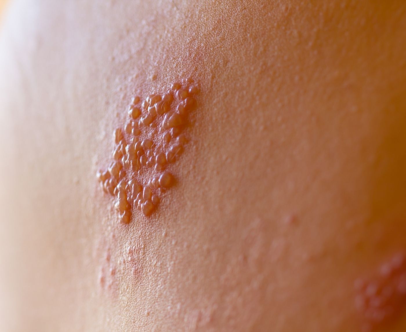 Mouth or Genitals, What Kind of Herpes Do You Actually Have?