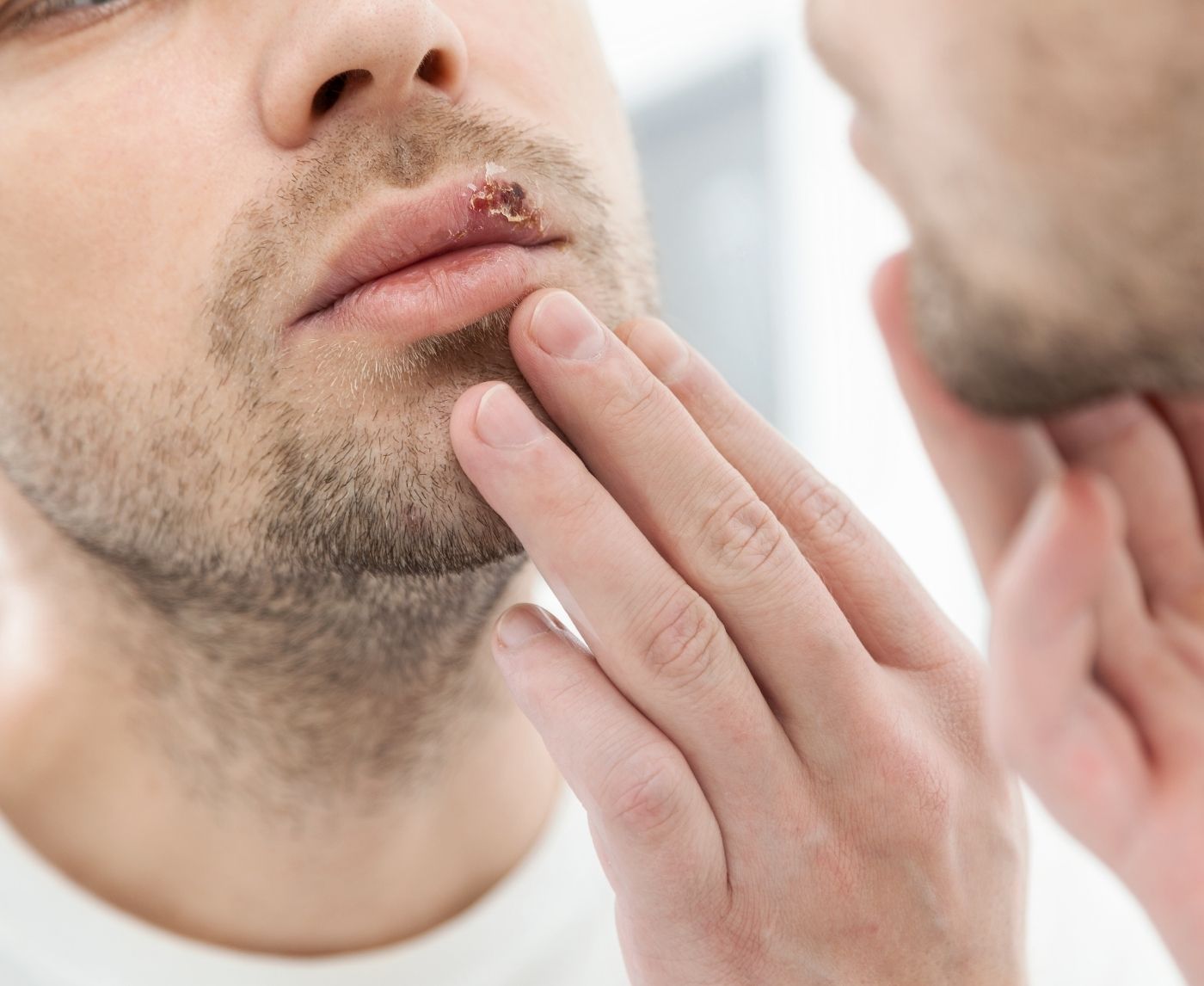 Can You Get Genital Herpes on Your Face? The Truth About HSV Types