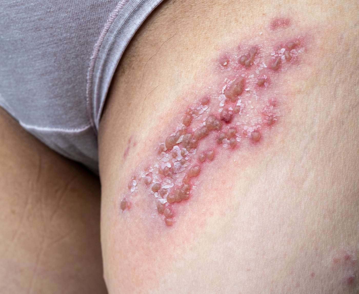 Is That a Pimple, Herpes, or a Genital Wart?